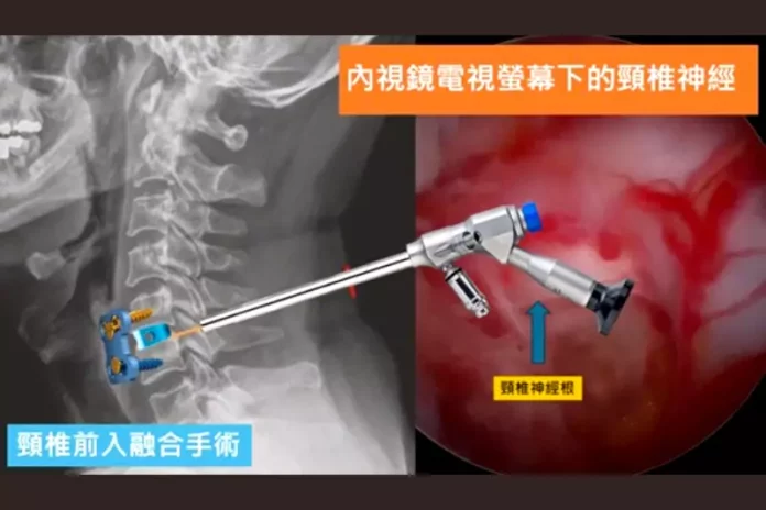 脊椎退化骨刺滑脫狹窄